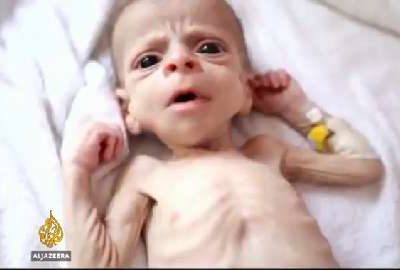 Children of Yemen suffering, wounded or dead