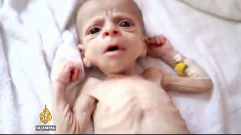 Children of Yemen suffering, wounded or dead