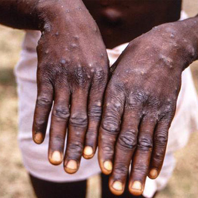 Monkeypox Vaccines, Brought to You By Joe Biden